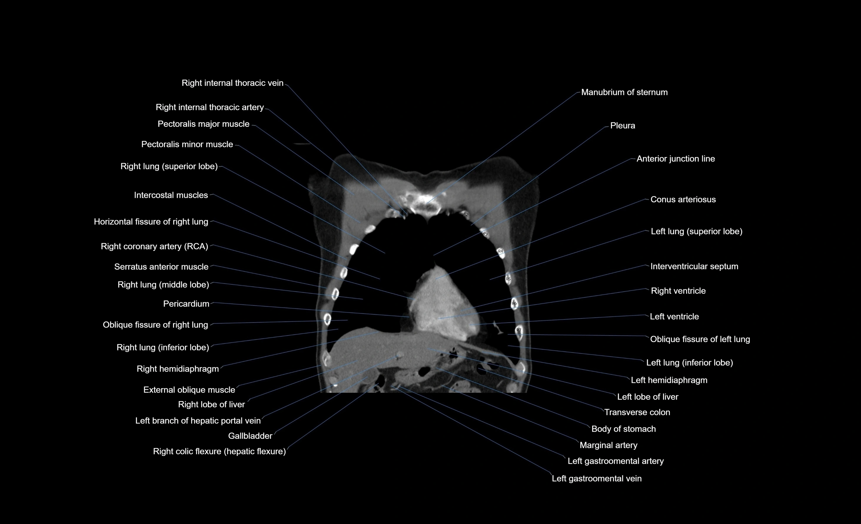 CT chest (thorax) labelled coronal cross sectional anatomy radiology image-00089.webp